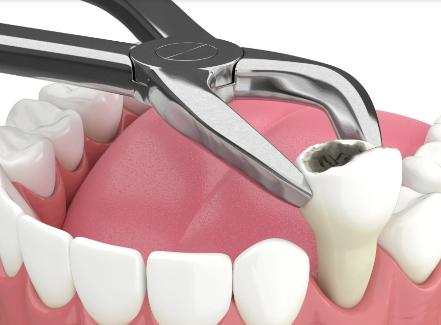 Dentist-Toa-Payoh-Tooth-Extraction